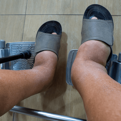 Shoes Don'T Fit Because Of Edema