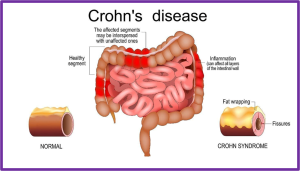 All You Need To Know About Crohn’s Disease &Raquo; Graphic Of Crohns Disease That I Got From Mehek Blog Author 300X171 1