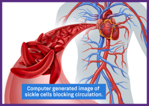 Managing Sickle Cell Disease