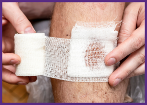Wound Management Guide For Patients And Caregivers &Raquo; Up Close Photo Of A Man Wrapping A Bandage Around A Wound On His Leg Canva Border Added 1 300X215 1