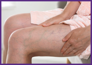 Early Signs Of Vascular Disease You Shouldn’t Ignore