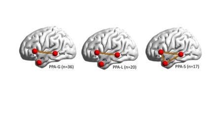 Map Of Broken Brain Networks Shows Why People Lose Speech In Language-Based Dementia &Raquo; Map Of Brain