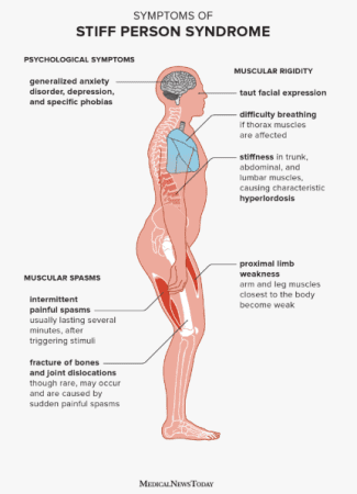 Understanding Stiff Person Syndrome &Raquo; Screenshot2023 07 178.37.57Am