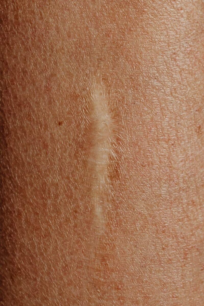 Close Up Of A Scar